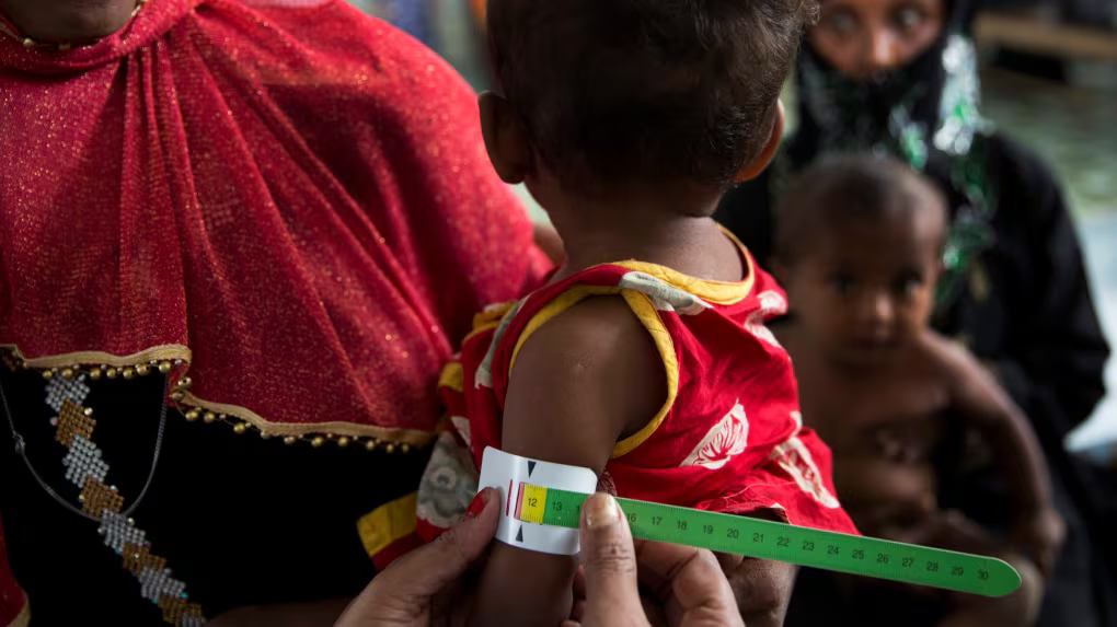 Malnutrition causes unrecognised type of diabetes: experts.