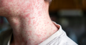 Measles cases surge in South Carolina as US risks losing elimination status.