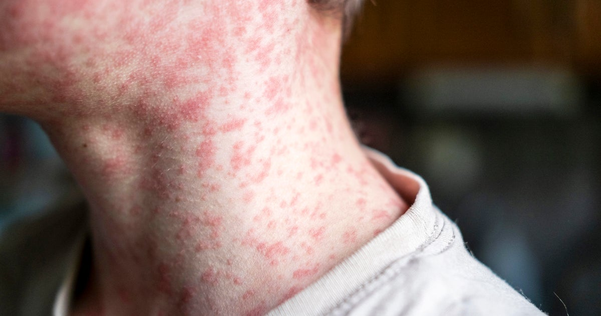 Measles cases surge in South Carolina as US risks losing elimination status.